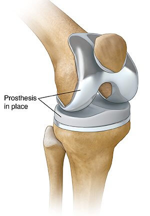 Knee Pain-2 (1)