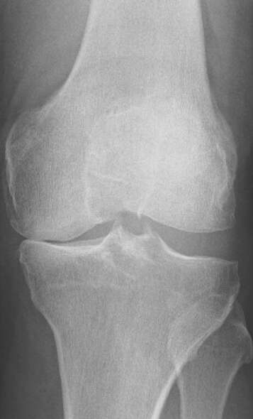 Knee pain-1 (1)